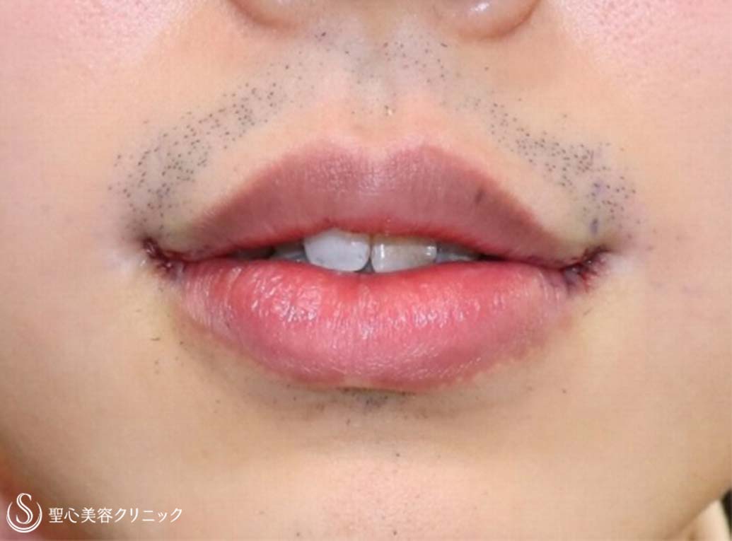 【20代男性・口角をあげて、いつでも微笑みを】プレミアム口角挙上術（術直後） After 