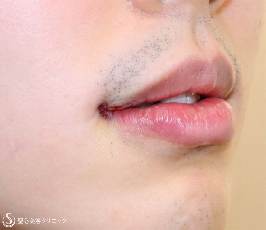 【20代男性・口角をあげて、いつでも微笑みを】プレミアム口角挙上術（術直後） After 