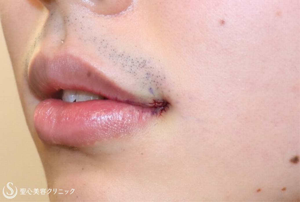 【20代男性・口角をあげて、いつでも微笑みを】プレミアム口角挙上術（術直後） After 