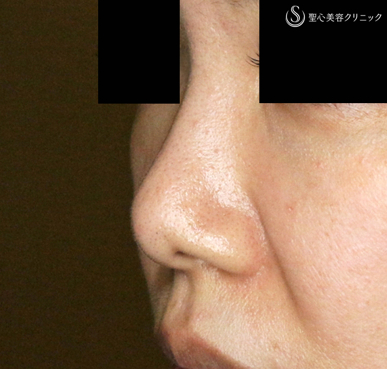 【30代女性・耳介軟骨いらずの団子鼻の治療】鼻尖縮小術+α法 単独（10年後） After 