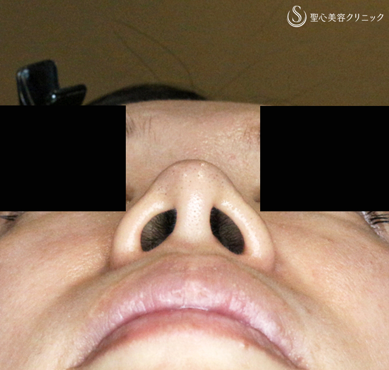 【30代女性・耳介軟骨いらずの団子鼻の治療】鼻尖縮小術+α法 単独（10年後） After 