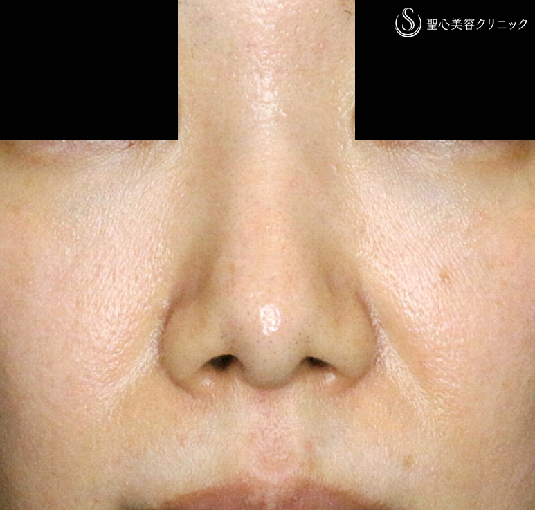 【30代女性・耳介軟骨いらずの団子鼻の治療】鼻尖縮小術+α法 単独（10年後） After 