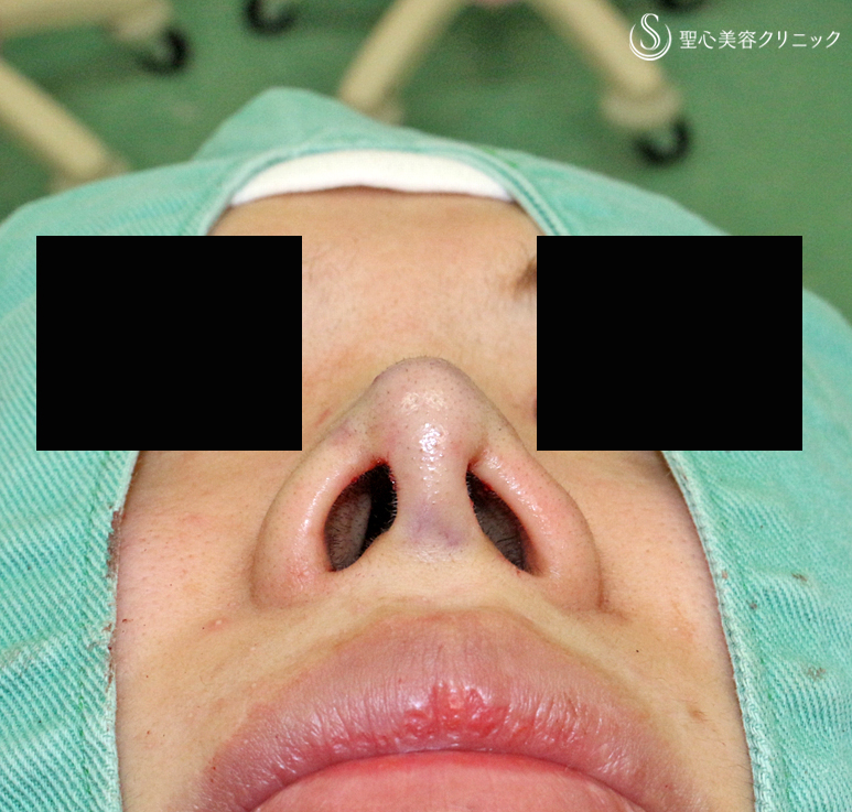 【30代女性・耳介軟骨いらずの団子鼻の治療】鼻尖縮小術+α法 単独（10年後） Before 