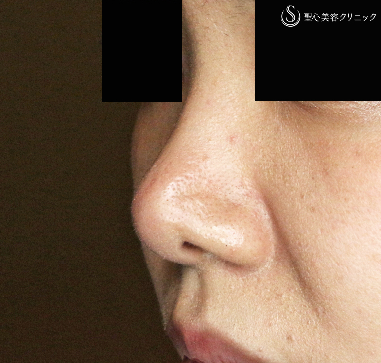 【30代女性・耳介軟骨いらずの団子鼻の治療】鼻尖縮小術+α法 単独（10年後） After 