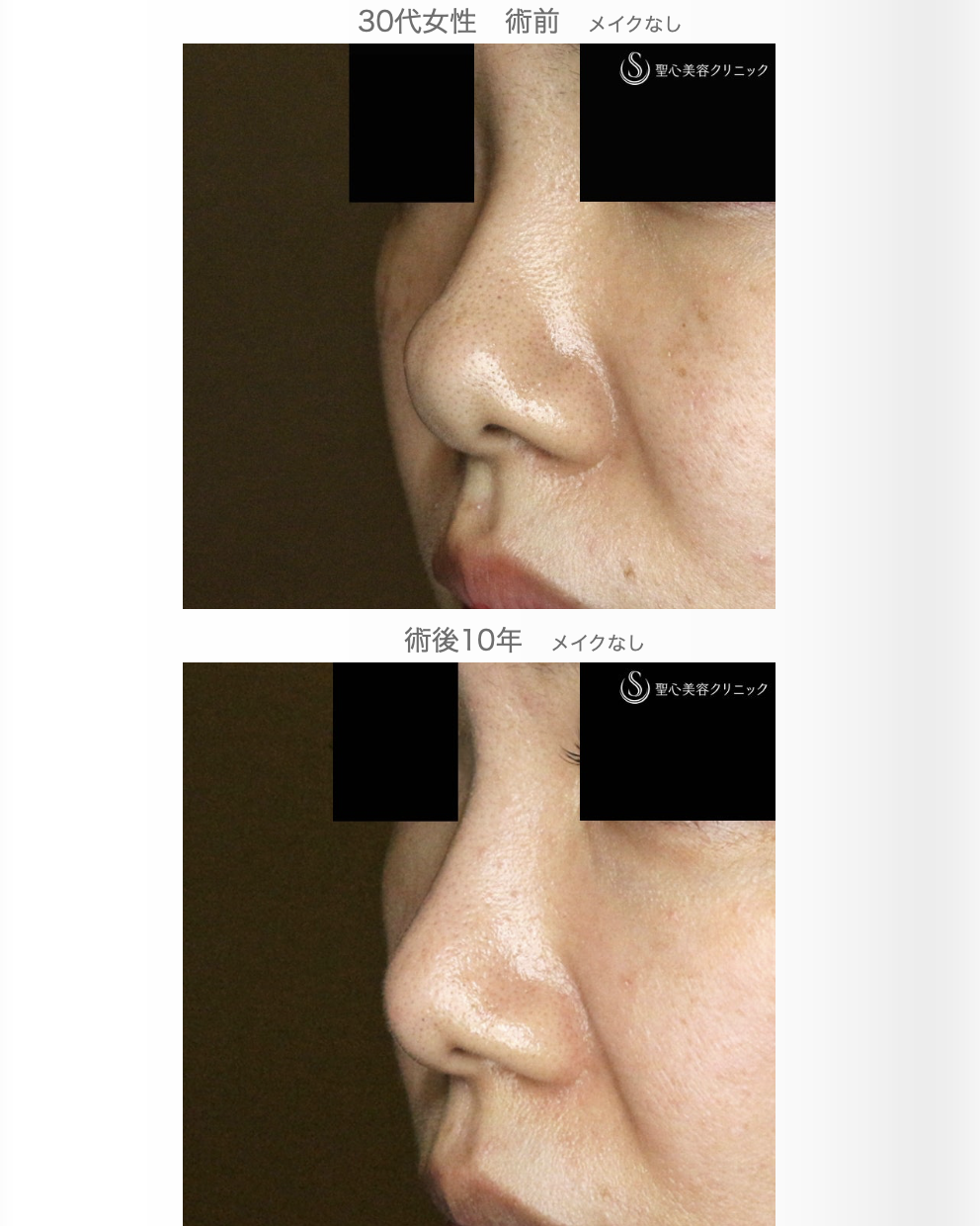 【30代女性・耳介軟骨いらずの団子鼻の治療】鼻尖縮小術+α法 単独（10年後） After 