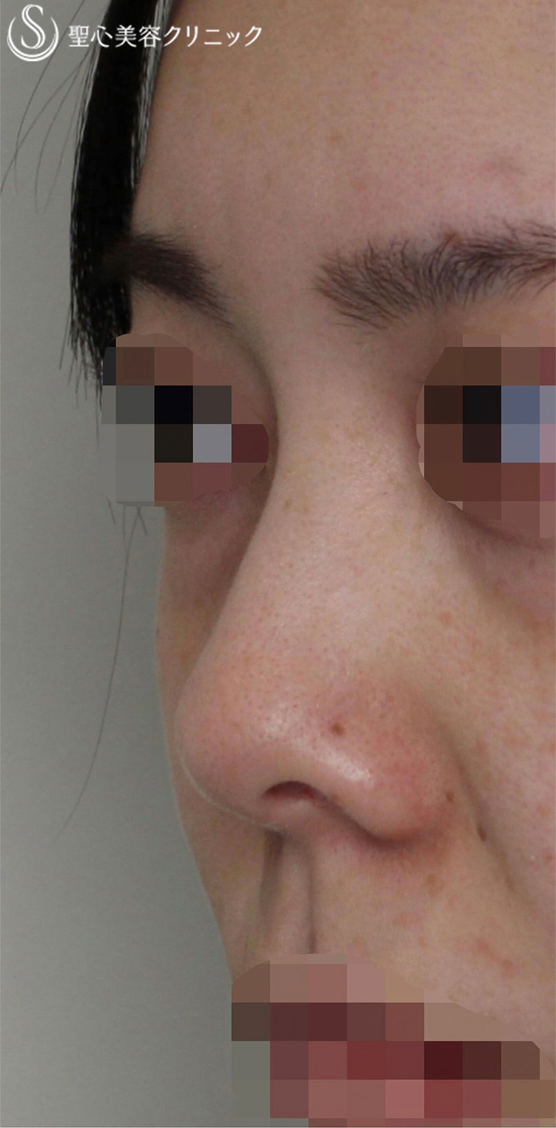 【20代女性・鼻の穴を目立ちにくく、鼻筋をスッキリ！！】Gメッシュ（4本）＋鼻孔縁下降術（術後1.5ヶ月） Before 