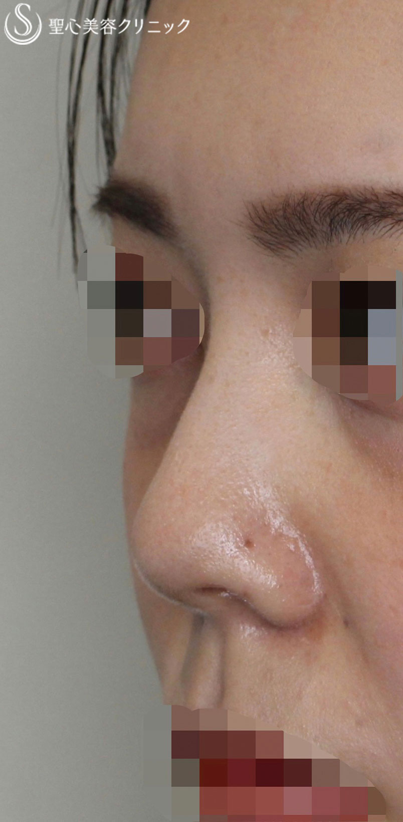 【20代女性・鼻の穴を目立ちにくく、鼻筋をスッキリ！！】Gメッシュ（4本）＋鼻孔縁下降術（術後1.5ヶ月） After 