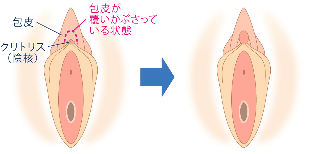 クリトリス包茎とは