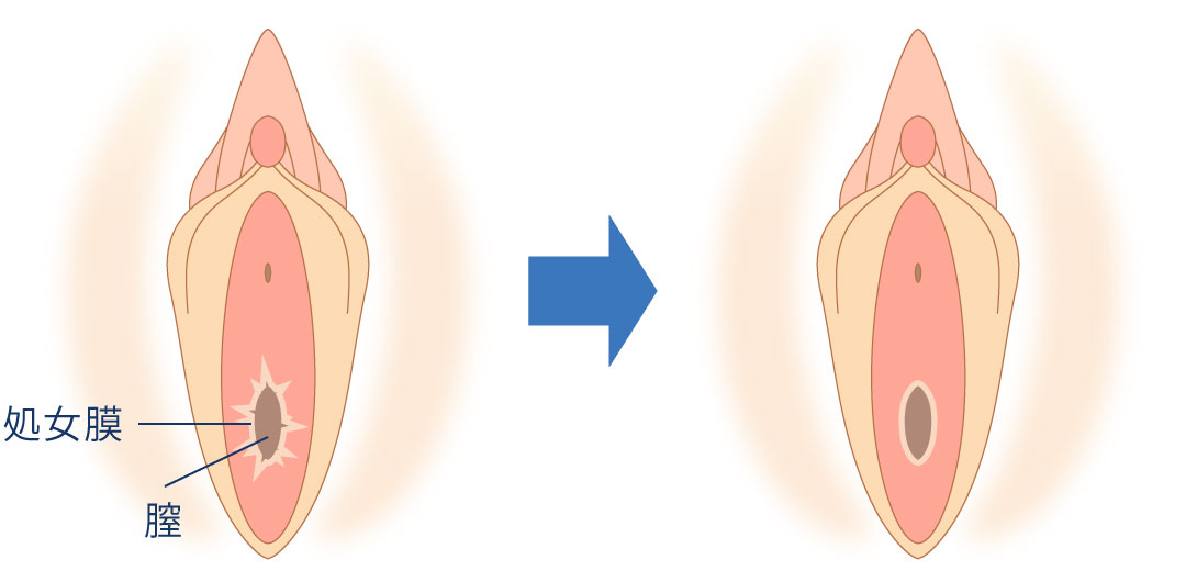 処女膜 処女膜切開術 | 大阪（心斎橋、梅田）・福岡（博多）のWクリニック