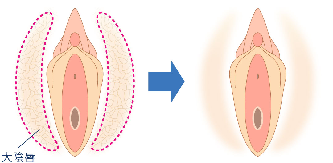 大陰唇縮小とは