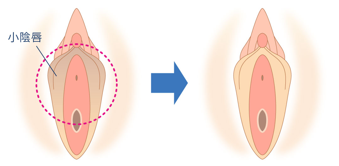 小陰唇縮小