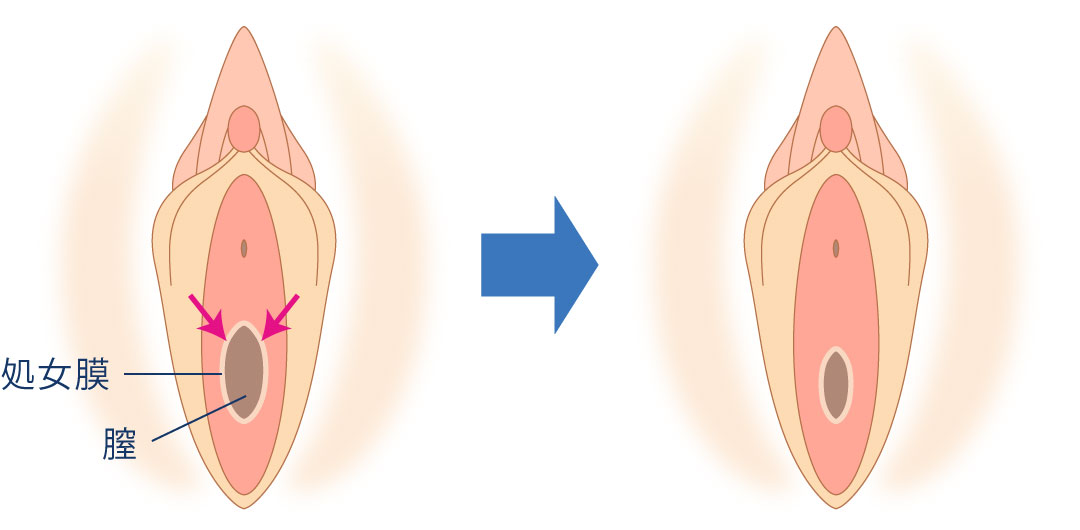 膣縮小とは