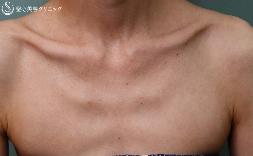 【40代女性・デコルテ】プレミアムPRP皮膚再生療法（3か月後） Before 