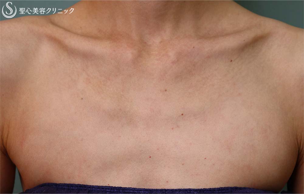 【40代女性・デコルテ】プレミアムPRP皮膚再生療法（3か月後） After 