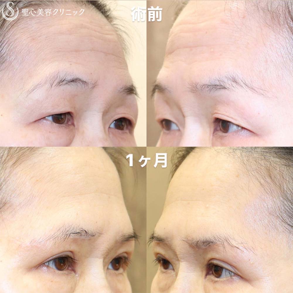 【60代女性・眉下リフトで一気に若返り】眉下切開法（眉下リフト）＋二重術（埋没法）：マイクロメソッド+α（1ヶ月後） After 