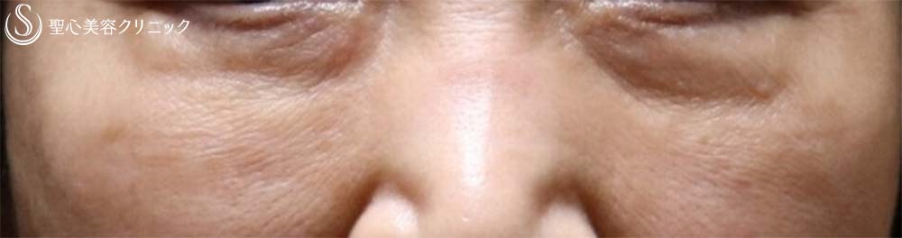 【60代女性・目元のアンチエイジング】眉下切開、プレミアムPRP皮膚再生療法（3か月後） Before 