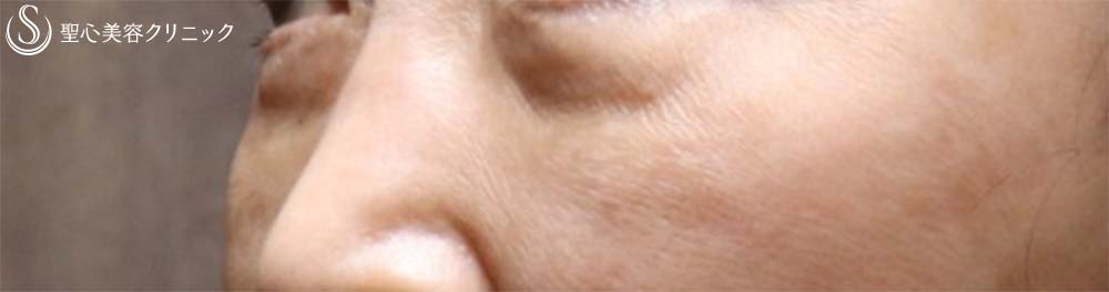 【60代女性・目元のアンチエイジング】眉下切開、プレミアムPRP皮膚再生療法（3か月後） Before 
