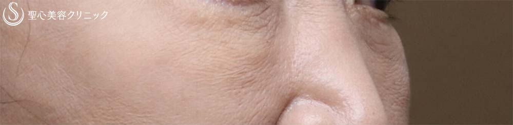 【60代女性・目元のアンチエイジング】眉下切開、プレミアムPRP皮膚再生療法（3か月後） After 