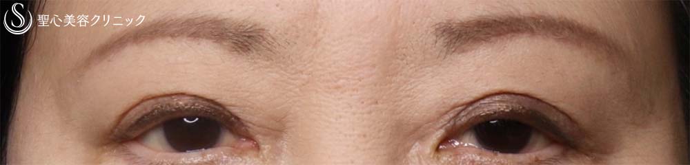 【60代女性・目元のアンチエイジング】眉下切開、プレミアムPRP皮膚再生療法（3か月後） After 