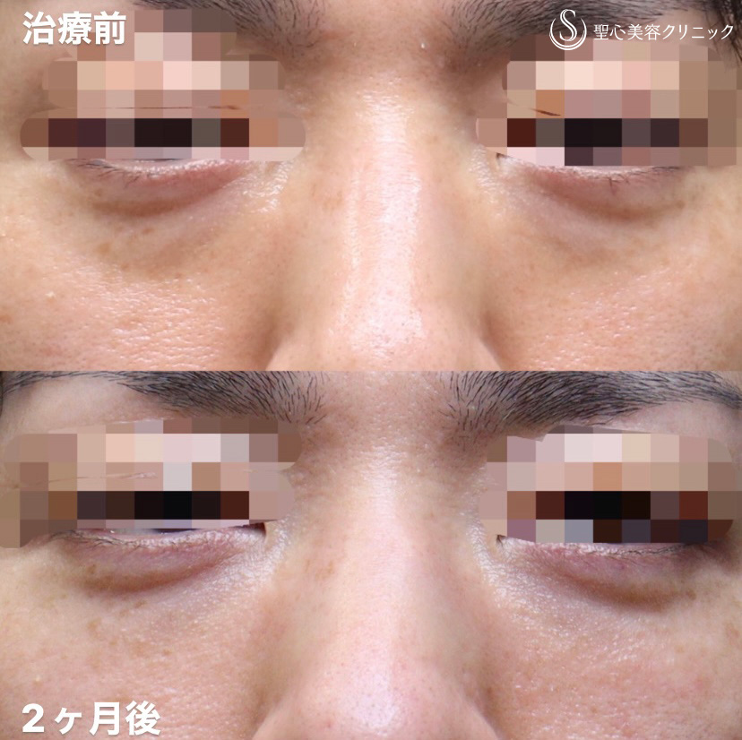 【30代男性・目の下のクマを撃退】プレミアムPRP皮膚再生療法（2ヶ月後） Before 