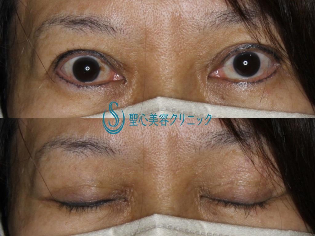 【50代女性・他院二重切開後の右眼瞼下垂修正術】眼瞼下垂（埋没法）（手術直後） After 