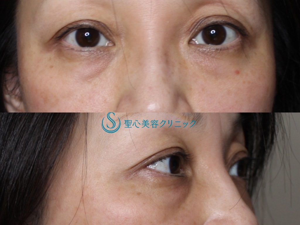 【40代女性・目の下の若返り】 経結膜下脱脂法+プレミアムPRP皮膚再生療法（１年後） Before 