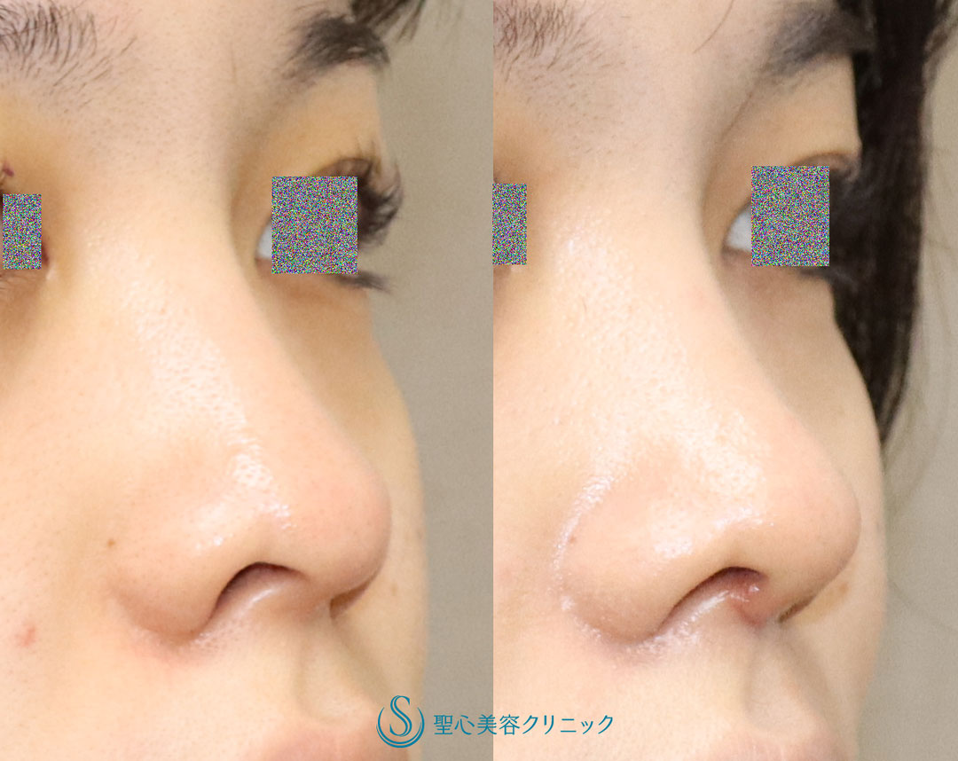 【20代女性・鼻先の丸みを自然に改善して鼻先を細くしたい】鼻尖縮小（オープン法）（1ヶ月後） After 