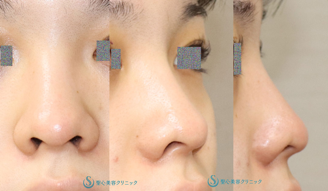 【20代女性・鼻先の丸みを自然に改善して鼻先を細くしたい】鼻尖縮小（オープン法）（1ヶ月後） Before 