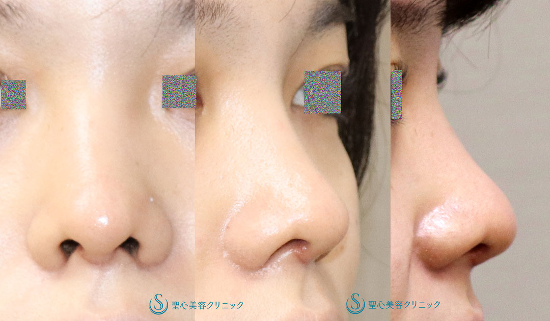 【20代女性・鼻先の丸みを自然に改善して鼻先を細くしたい】鼻尖縮小（オープン法）（1ヶ月後） After 