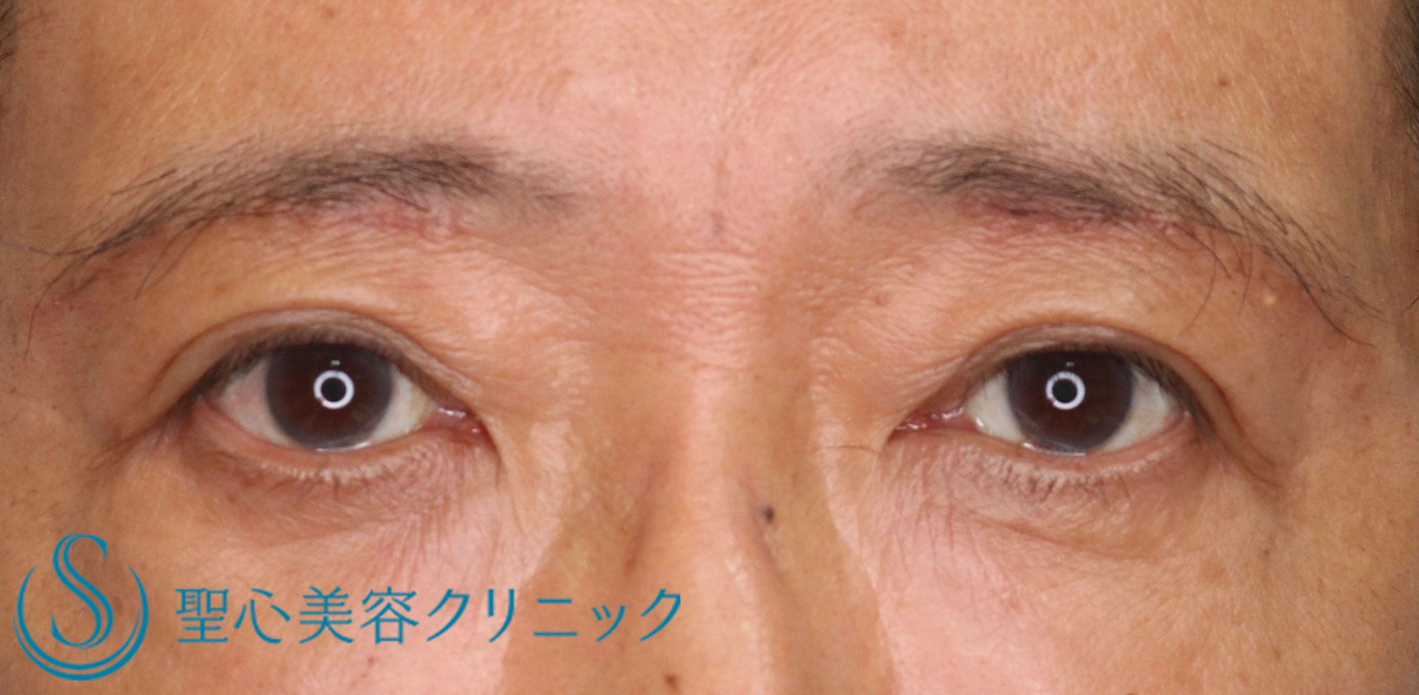 【60代男性・目の上のたるみを取ってスッキリ！！】眉下リフト（眉下切開法）（術後3週間） After 