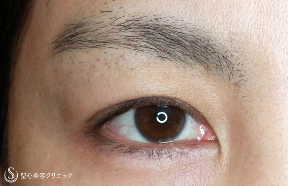 【40代女性・目の上のタルミ取り】眉下リフト長期経過（9年後） Before 