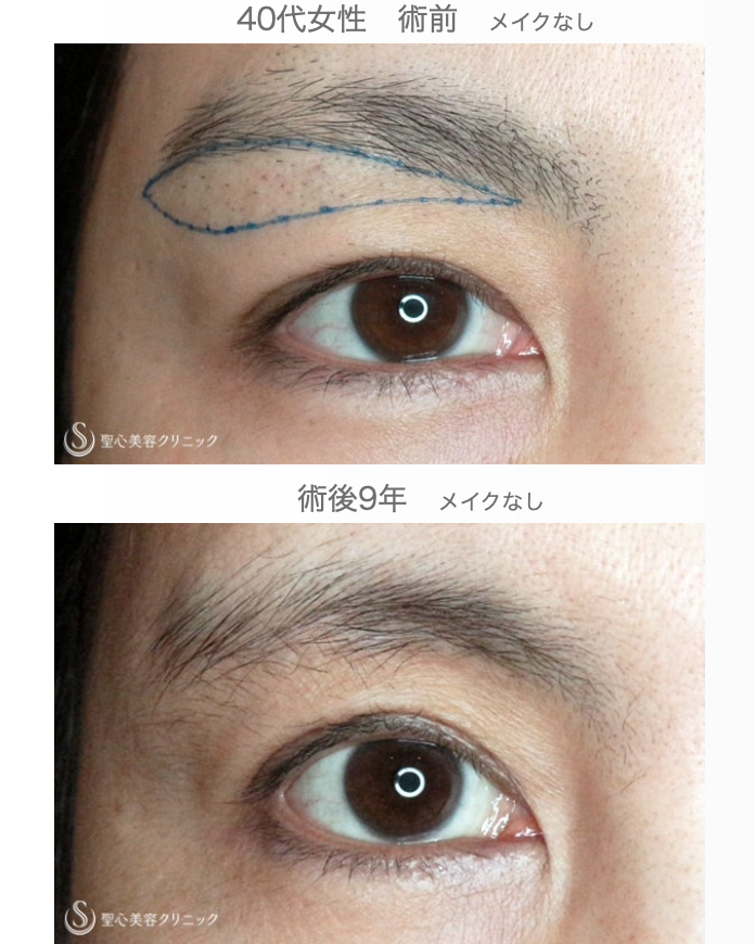 【40代女性・目の上のタルミ取り】眉下リフト長期経過（9年後） After 