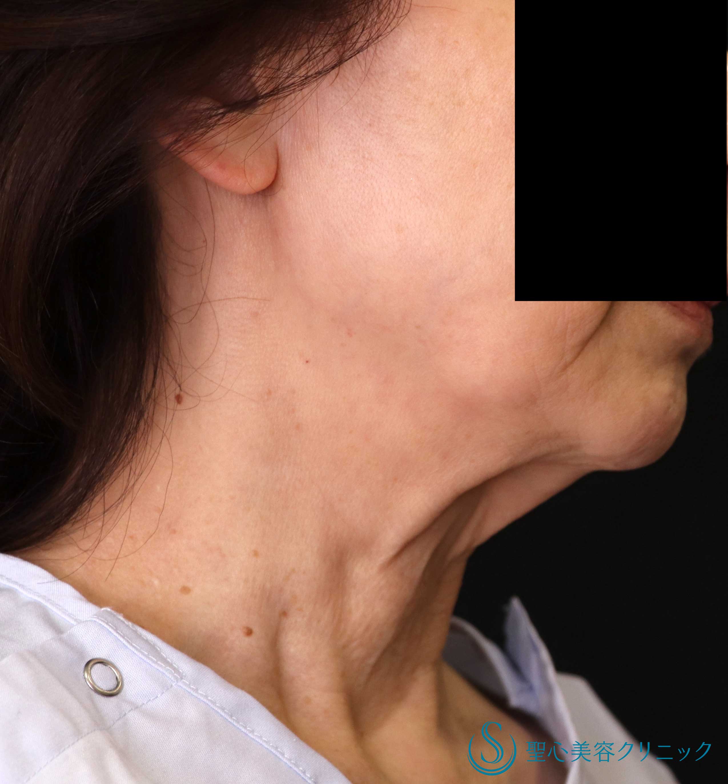 【60代女性・手術で首のたるみ改善】ネックリフト（1週間～1ヶ月後） Before 