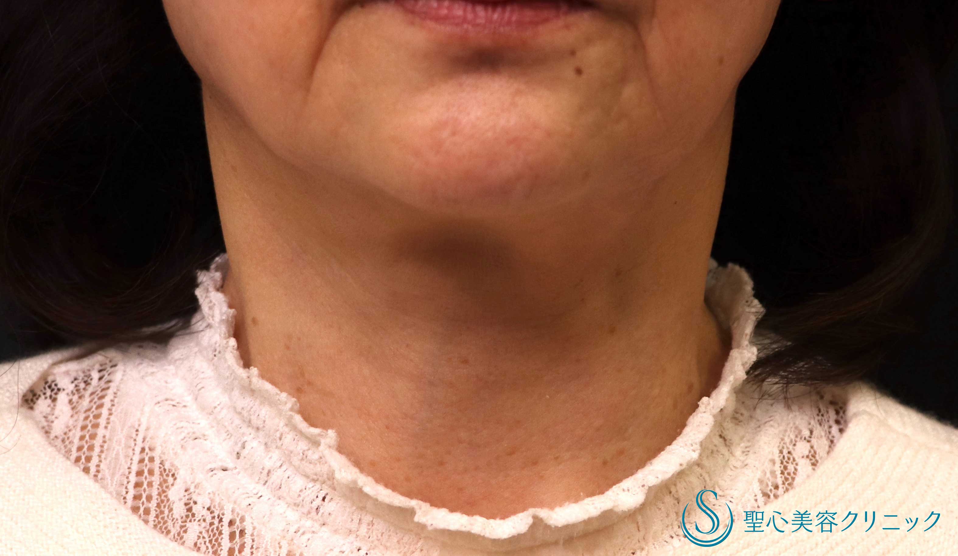 【60代女性・手術で首のたるみ改善】ネックリフト（1週間～1ヶ月後） After 