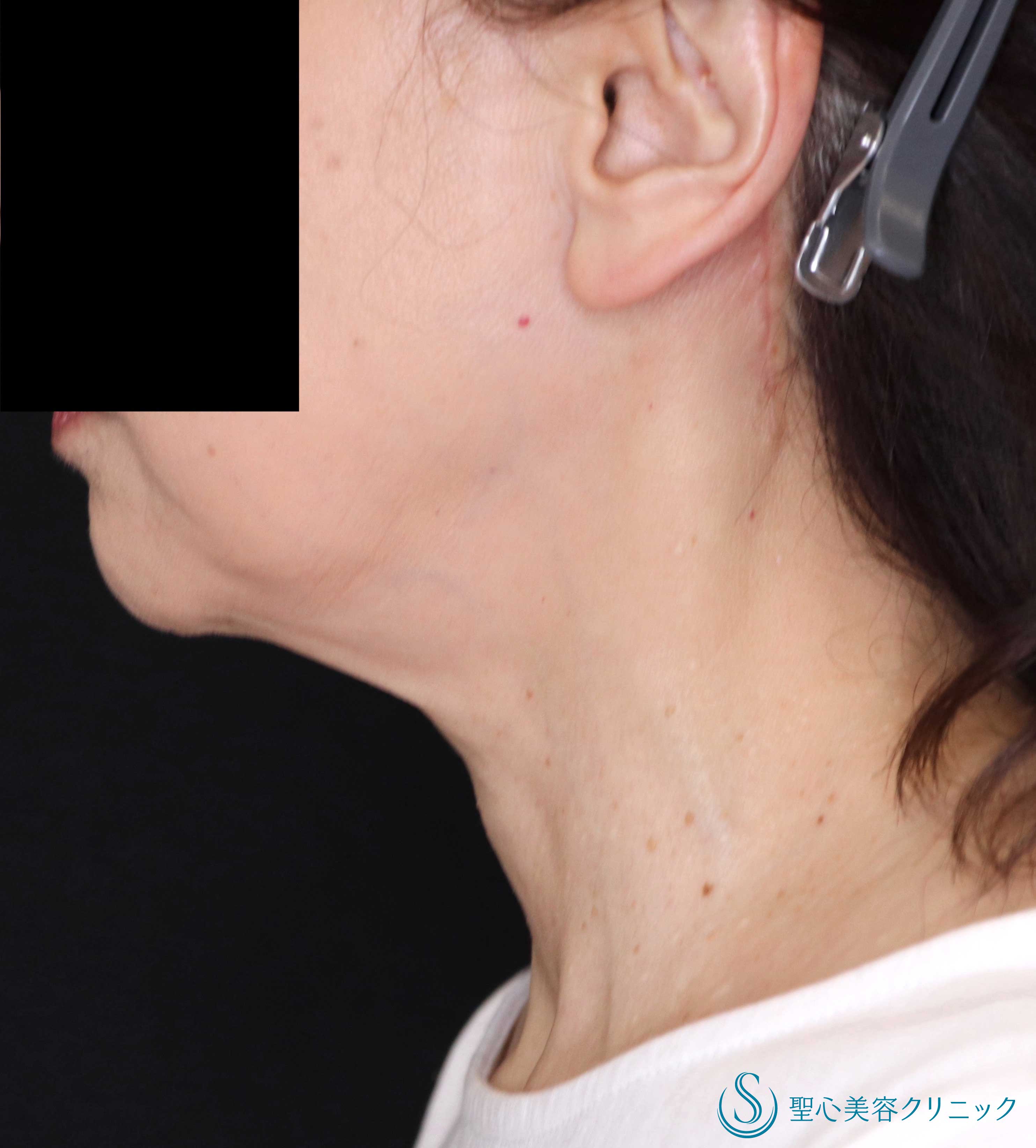 【60代女性・手術で首のたるみ改善】ネックリフト（1週間～1ヶ月後） After 