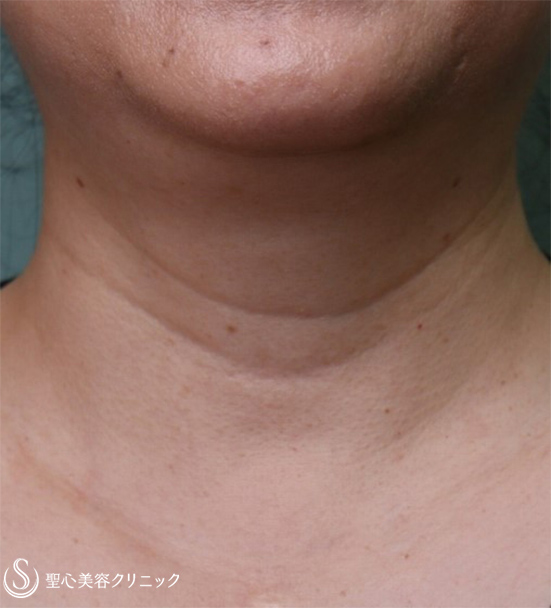 【50代女性・首の横じわ】プレミアムPRP皮膚再生療法（7か月後） Before 