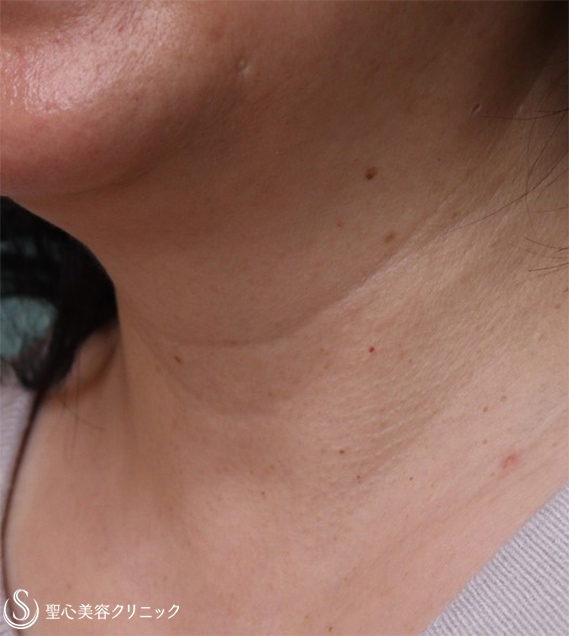 【50代女性・首の横じわ】プレミアムPRP皮膚再生療法（7か月後） After 