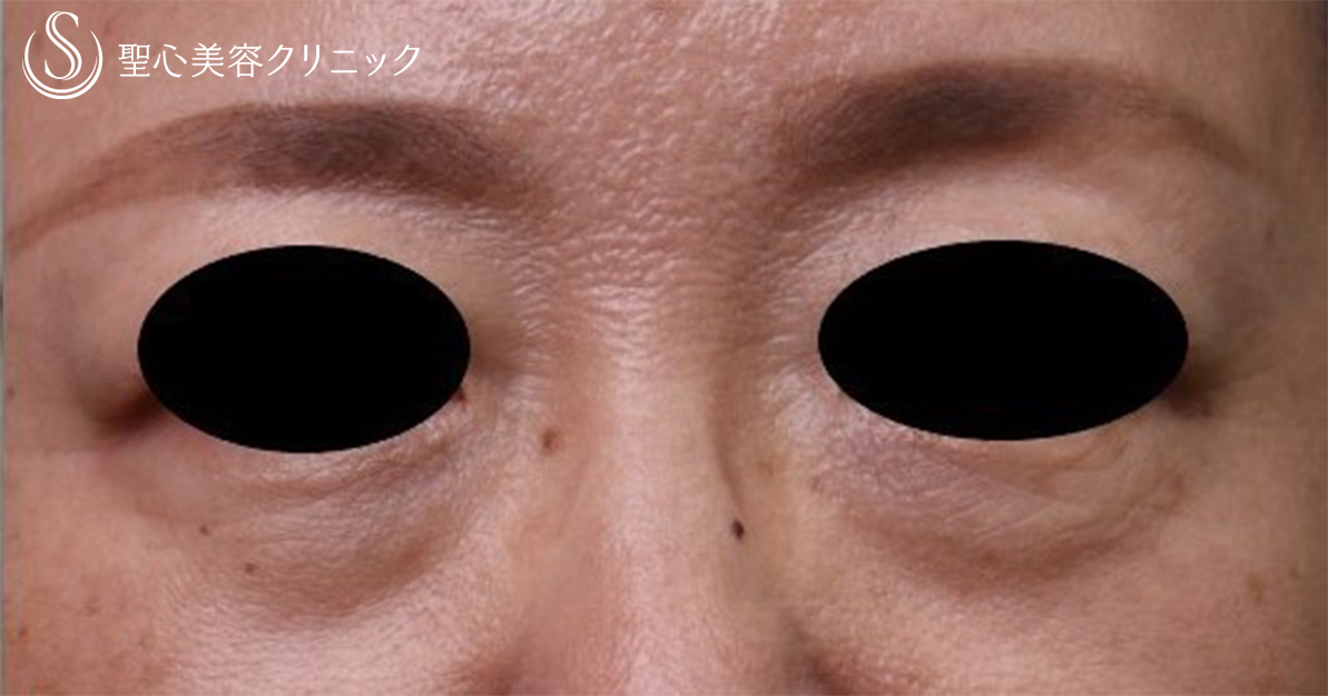 【50代女性・目の下のくま】プレミアムPRP皮膚再生療法（7ヶ月後） Before 