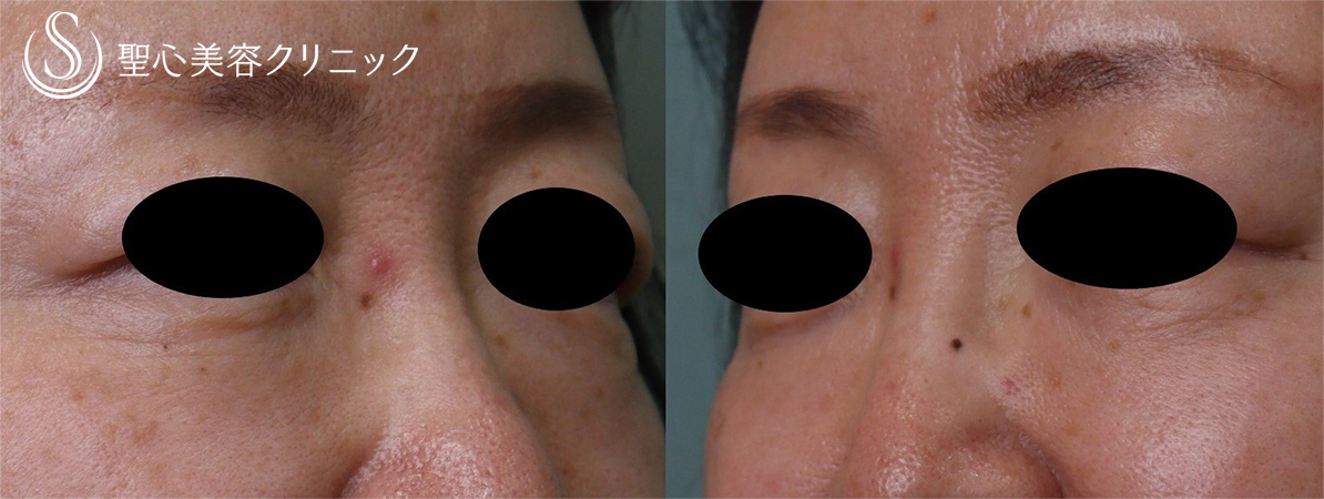 【50代女性・目の下のくま】プレミアムPRP皮膚再生療法（7ヶ月後） After 