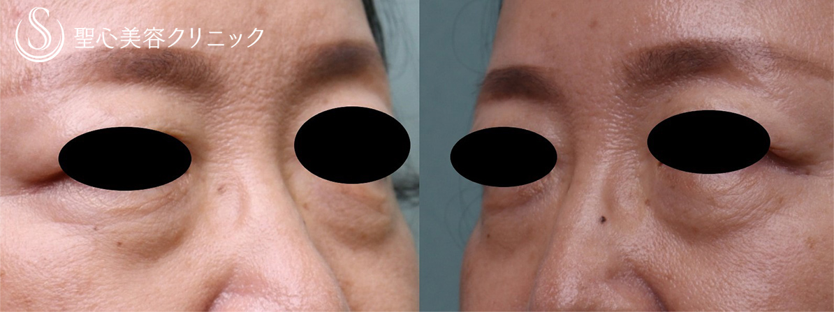【50代女性・目の下のくま】プレミアムPRP皮膚再生療法（7ヶ月後） Before 