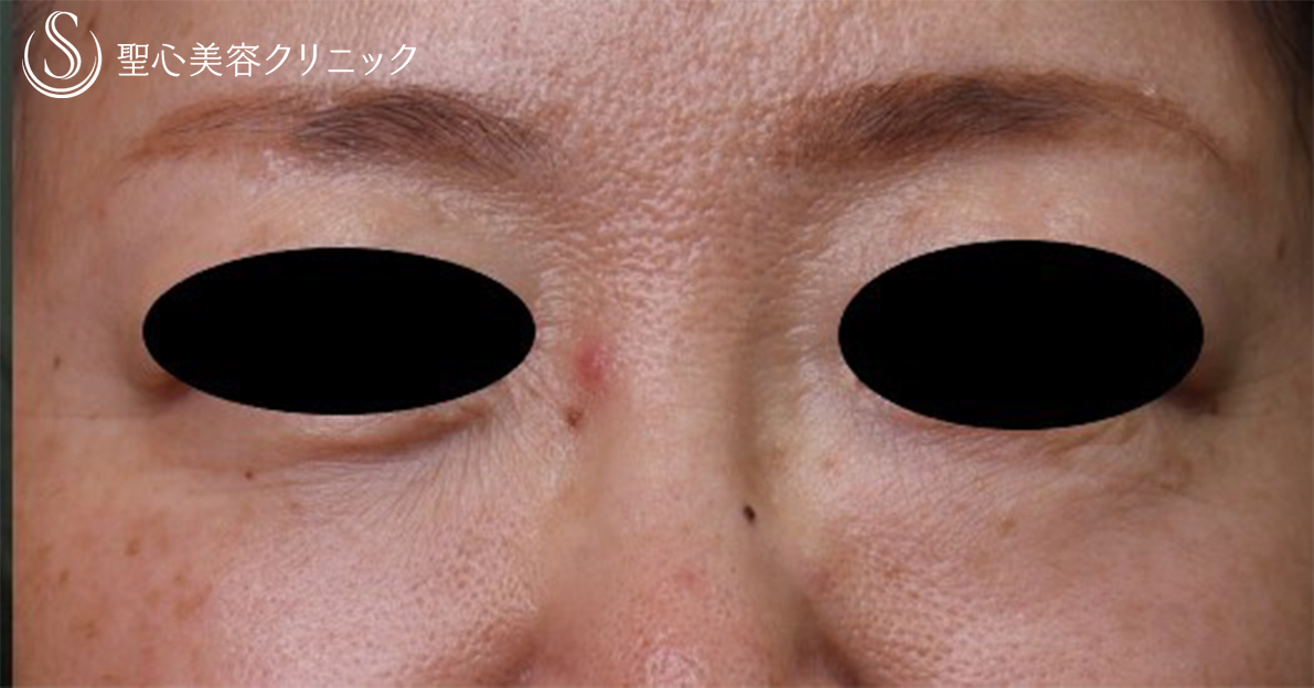 【50代女性・目の下のくま】プレミアムPRP皮膚再生療法（7ヶ月後） After 