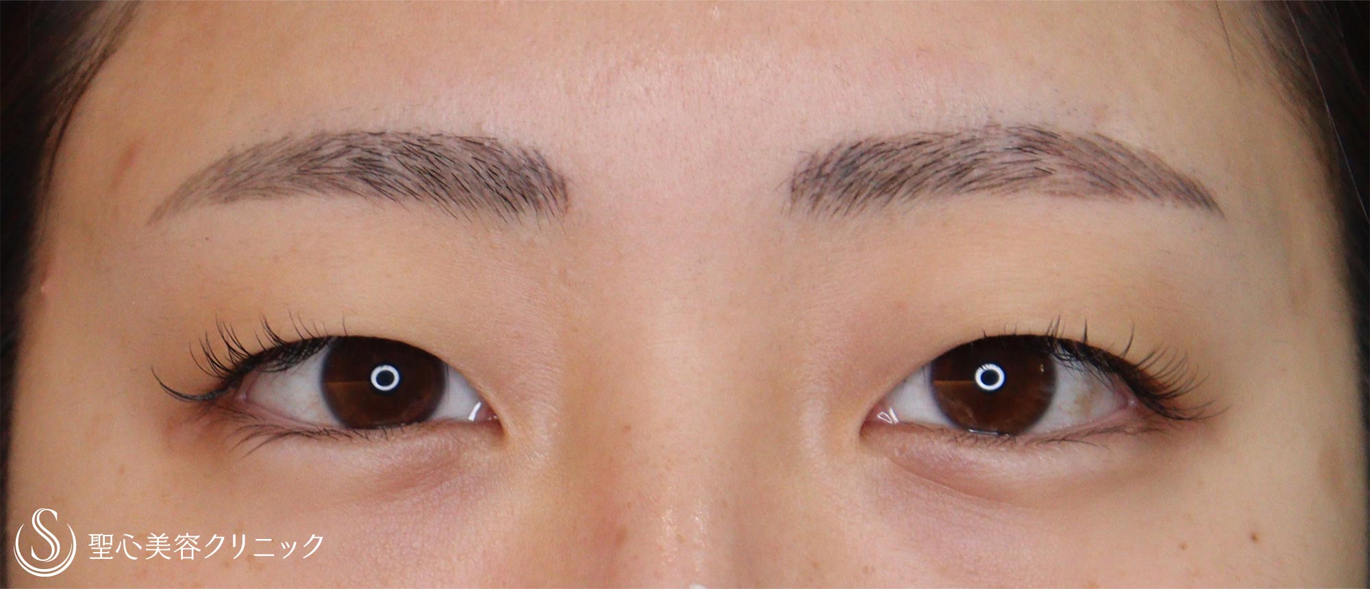 【20代女性・重いまぶた】眉下切開（1ヶ月後） Before 
