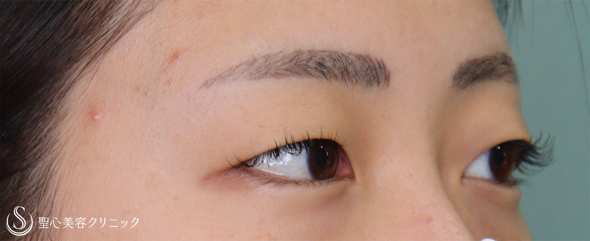 【20代女性・重いまぶた】眉下切開（1ヶ月後） Before 