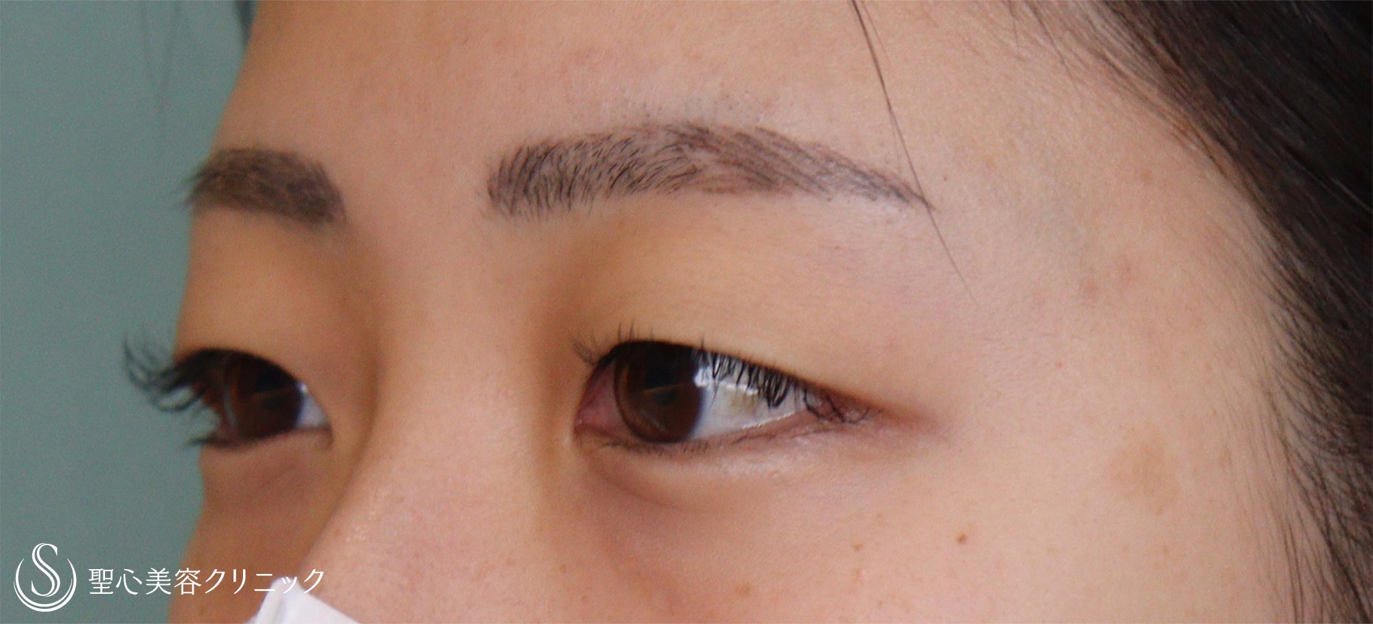【20代女性・重いまぶた】眉下切開（1ヶ月後） Before 