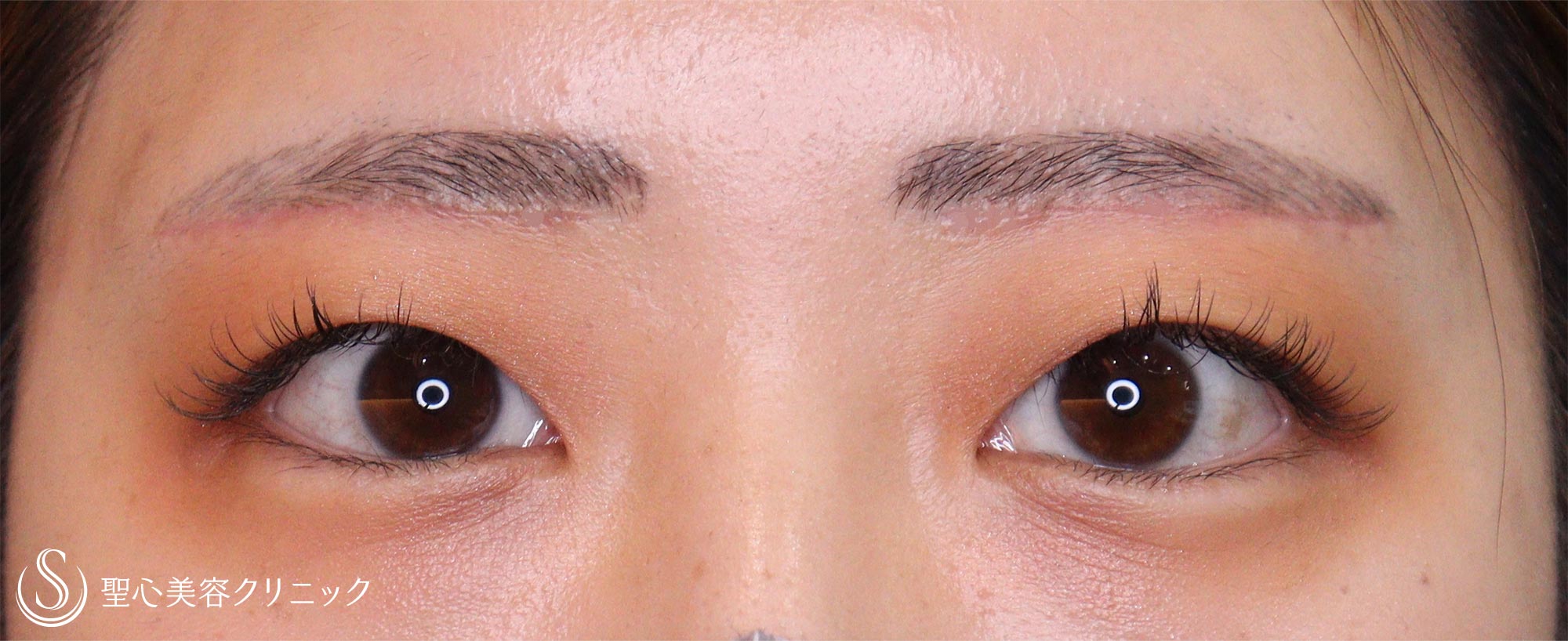 【20代女性・重いまぶた】眉下切開（1ヶ月後） After 