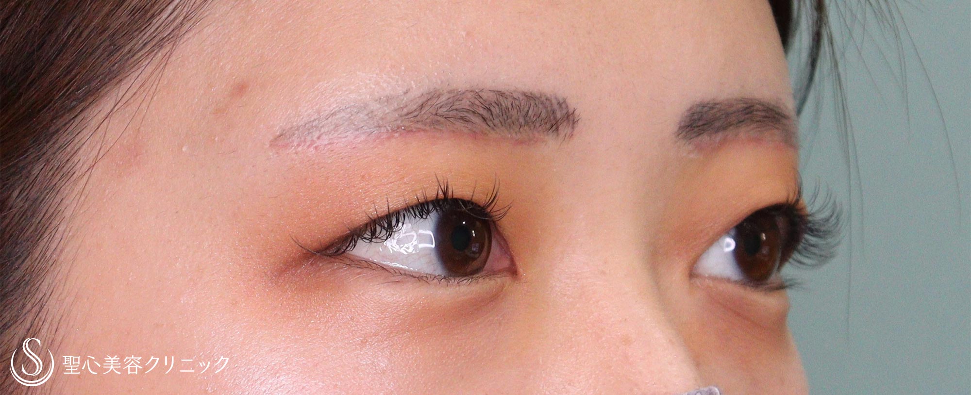 【20代女性・重いまぶた】眉下切開（1ヶ月後） After 