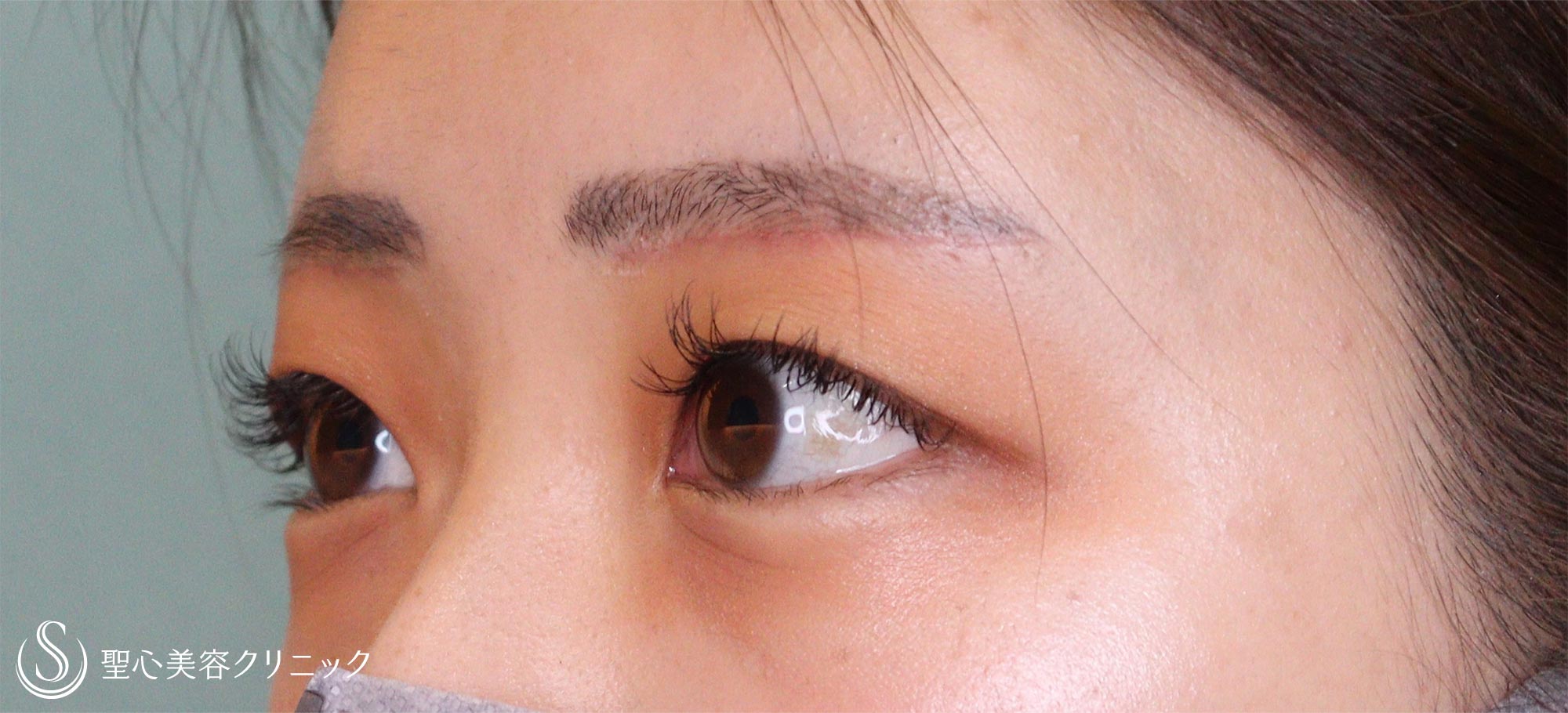【20代女性・重いまぶた】眉下切開（1ヶ月後） After 