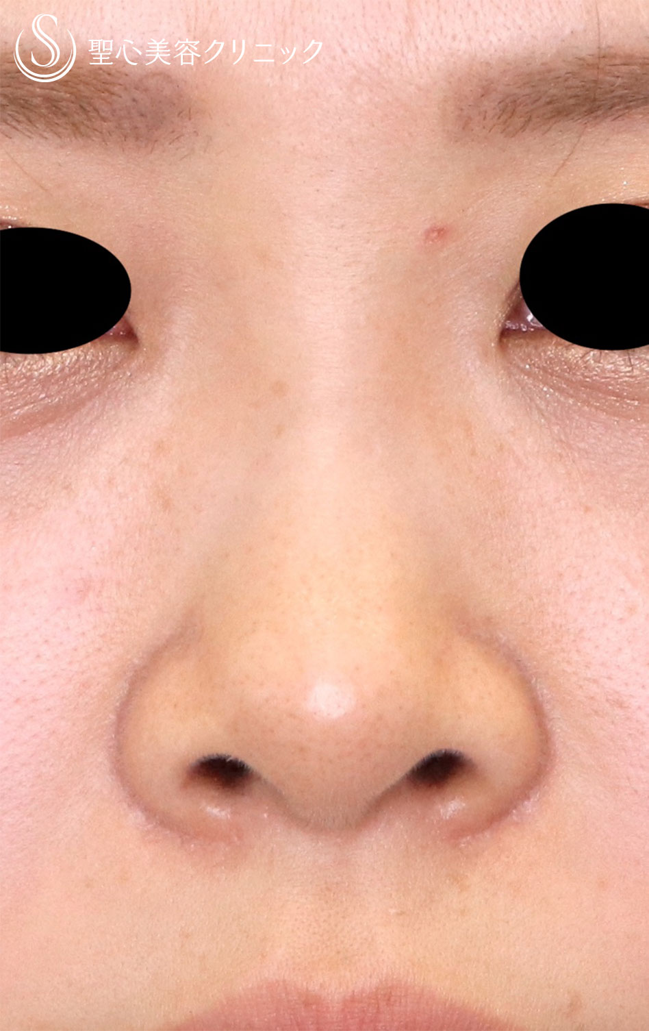 【20代女性・スッキリした鼻筋に】３Dプロテーゼ＋耳介軟骨（1週間後） Before 
