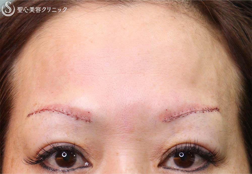 【40代女性・額のシワと瞼の重み改善】眉下切開＆プレミアムPRP皮膚再生療法（2か月後） Before 