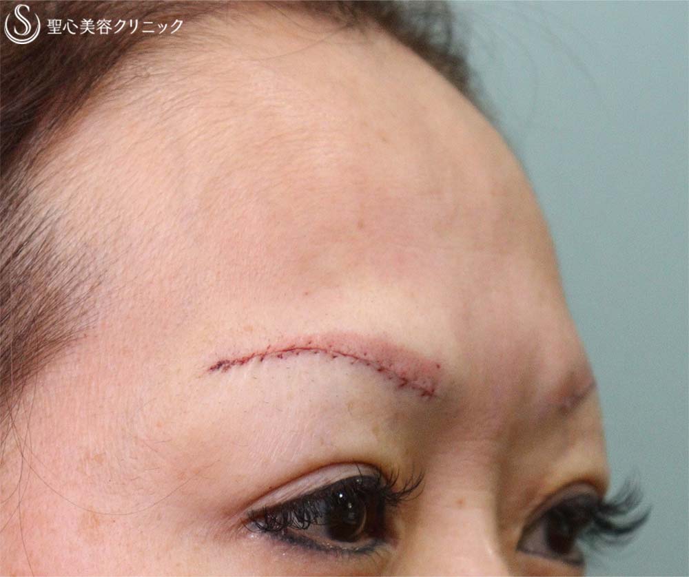 【40代女性・額のシワと瞼の重み改善】眉下切開＆プレミアムPRP皮膚再生療法（2か月後） Before 